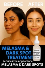 Melasma Dark Spot Corrector – Extra Strength Brightening Serum for Face & Body
