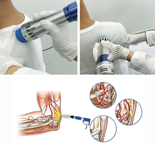 Shockwave Therapy Machine Professionelle Stoßwellentherapie ED Extrakorporale - Bild 8 von 23
