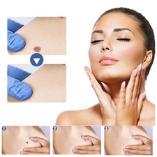 Wart Remover Patches for Skin Corn Treatment with Plant Extracts