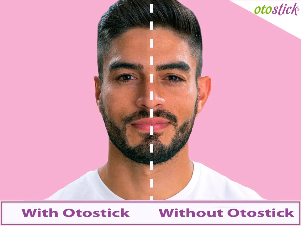 OTOSTICK BABY BIG BAT PROMINENT EAR CORRECTOR NONSURGERY OTOPLASTY Ear Pin - image 3 of 4