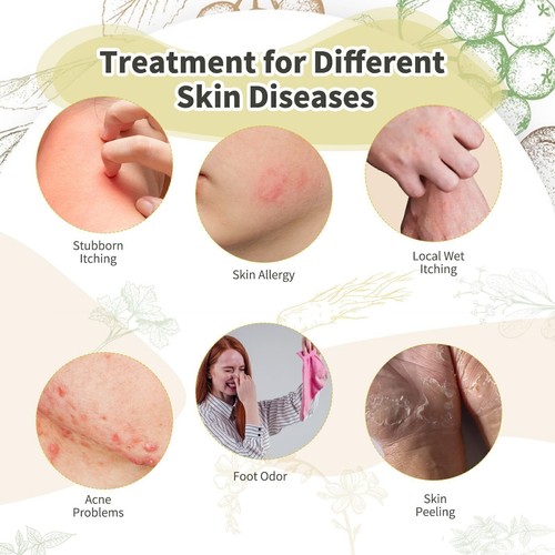 1/3/6pcs Eczema Cream Natural Organic Herbal Skin Cream Healing Cream - Afbeelding 7 van 11