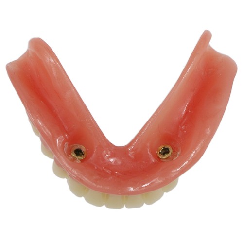 Demo modello denti Typodont restauro overdenture dentale con 2 impianti modello - Foto 4 di 12