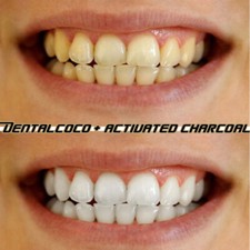 Teeth Whitening Kit Tooth Bleaching Professional Kit Activated Charcoal New Best