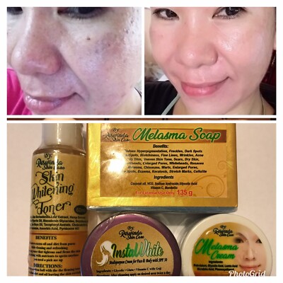 toner melasma