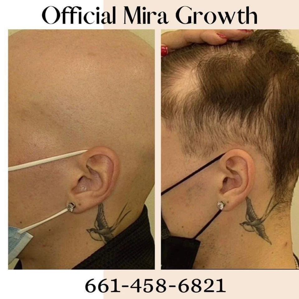 Kit completo de pérdida/crecimiento del cabello (3 meses) Foto 2 de 3