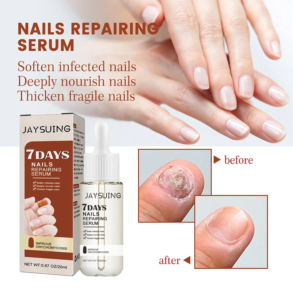 Amazon.com : Abera Fungus Treatment For Toenail Or Fingernail, Nail Repair  Solution, Nail Renewal Liquid For Damaged & Discoloration Nail : Beauty &  Personal Care