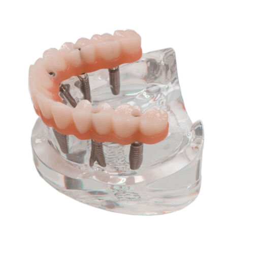 Implante dental todo en 4/6 sobredentadura modelo mandíbula superior restauración 4/6 tornillos - Imagen 14 de 26