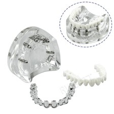 Dental Implant Model Upper Lower Jaw 4 Implants Overdenture Restoration Model