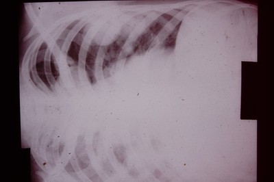 No Date Medical Slide X-Ray Mass Produced  Slide CD-L