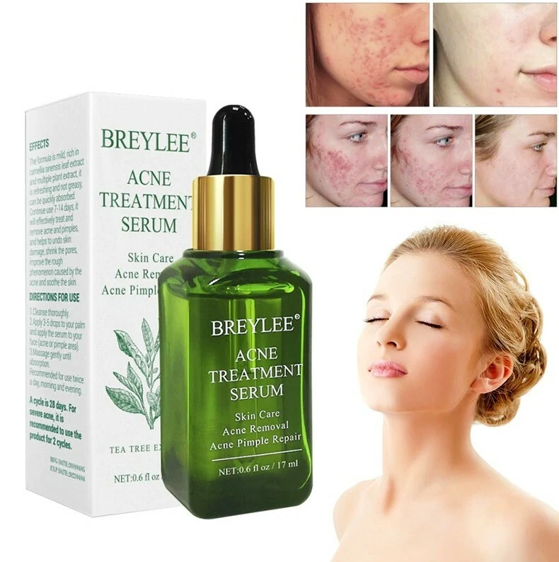 Acne treatment essence cream deals