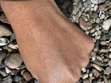 Intense Treatment for Eczema Rosacea cream Eczema