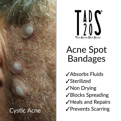 hydrocolloid dressing cystic acne 40/200 ZIT STICKERS, Pimple Patches, Cystic Acne Patch, Hydrocolloid Acne  Dots