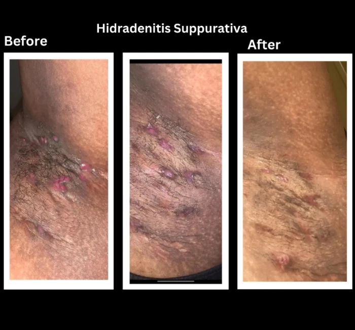 4 унц. Крем для гнойного гидраденита - Изображение 4 из 4