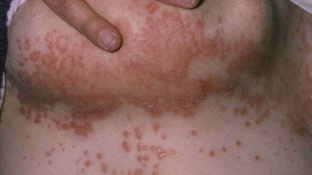 Clear Dark Underarms Discoloration Candidiasis Rash Intertrigo Psoriasis EBay
