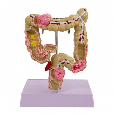 Modèle du Gros Intestin Détaillé Modèle de Pathologie Intestinale Support - Photo 1/4