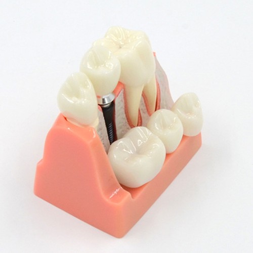 Flexible Dental Teeth Model Tooth Implant Model for Dentist Studying Teaching - Picture 5 of 8