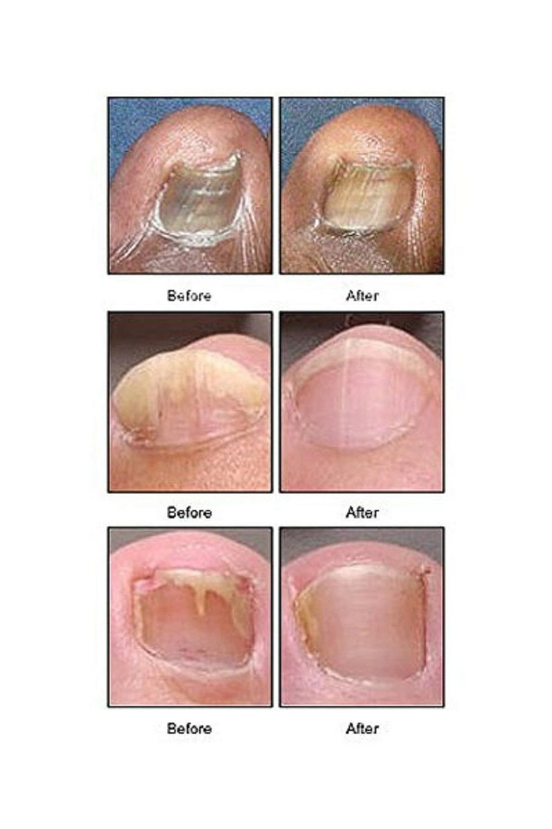 Nonyx Fungal Nail Clarifying Gel 4 Oz Removing Keratin