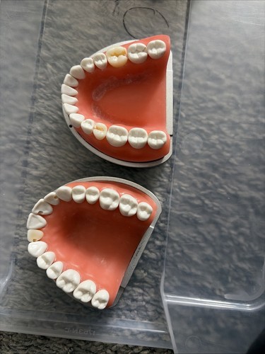 ADEX /cita/ Wreb Acadental Restorative Inserts With Carrier Plates Used