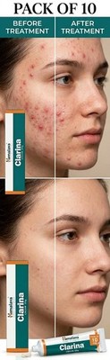 Pack of 10 - Himalaya Clarina Cream 30g | Wholesale Acne & Pimple Solution.