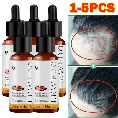 LEWEDO 5/3Pcs Batana Oil Serum for Hair Growth for Healthier Thicker Fuller Hair 50ml