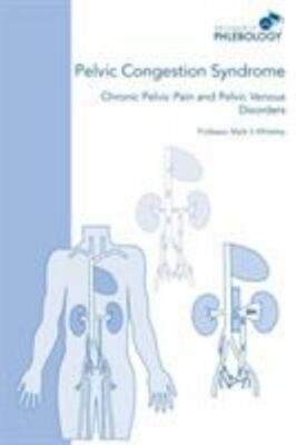 Pelvic Congestion Syndrome - Chronic Pelvic Pain and Pelvic Venous Disorders, Wh