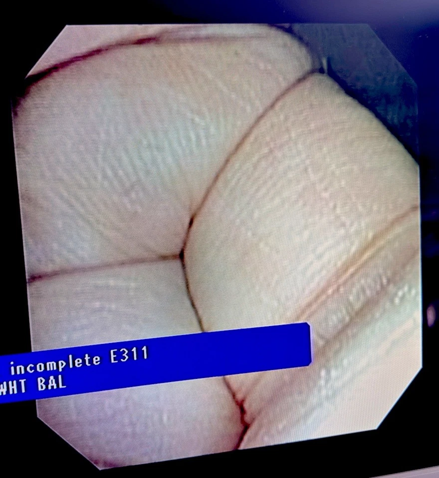 Video histeroscopio flexible Olympus HYF tipo V visera con estuche Foto 3 de 4