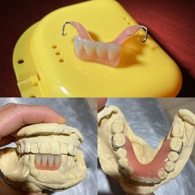 CUSTOM MISSING TEETH FLIPPER/ StayPlate for Upper Lower (Hard Acrylic MATERIAL)