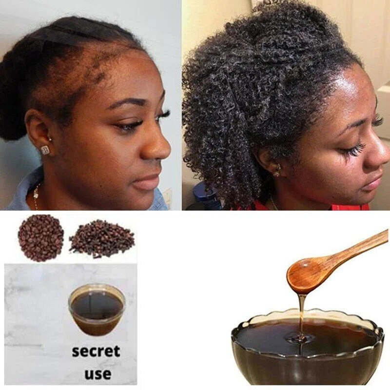 Hair Loss Treatment of Traction Alopecia Super Fast Hair Growth