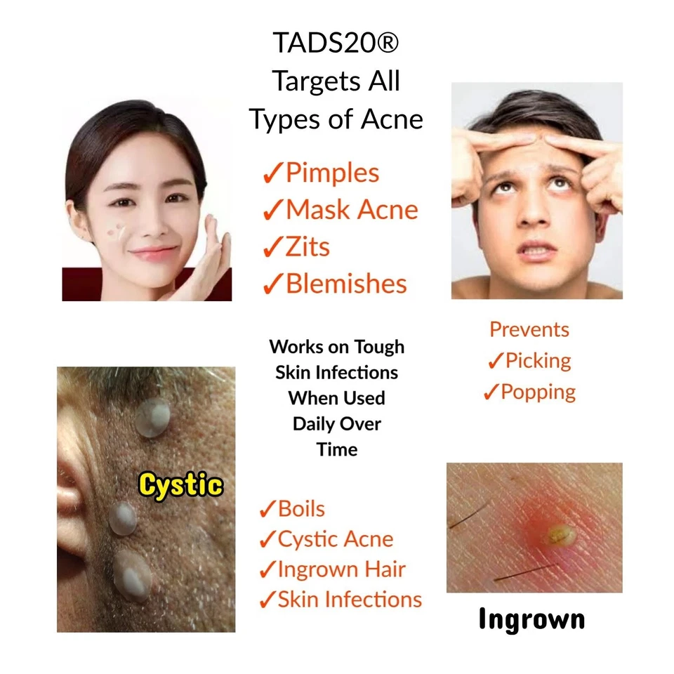 40 Acne Dots, Pimple Patches, Cystic Acne, Boils, Hydrocolloid Acne Spot Sticker - Image 3 of 4