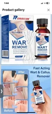 30ML Fast Acting Wart Freeze Off Wart Removal,17% Salicylic Acid Liquid Wart ...
