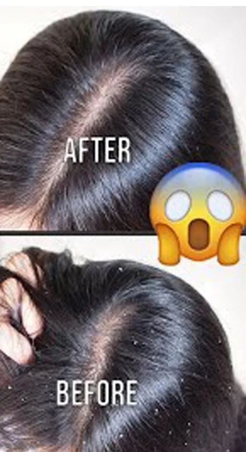 Anti Dandruff Shampoo for Oily Sensitive Scalp Prone to Dandruff & Folliculitis - Image 2 of 4