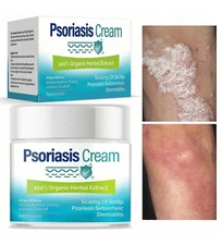 Psoriasis Cream, Scalp Treatment 100% Organic Herbal Extract 2oz