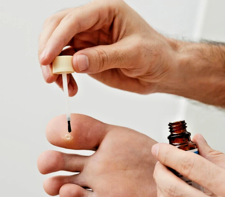 15ml Duofilm Salicylic Acid Removes Warts Corns Calluses Treatment