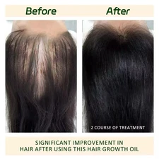 Hair Growth Serum for Women & Men – Fast Regrowth with Organic Herbs & Vitamins