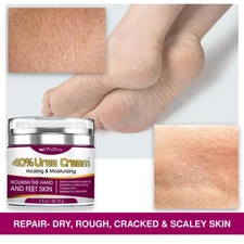 40% Urea Cream & 2% Salicylic Acid 4.6oz Callus Remover Foot Cream 56.70G