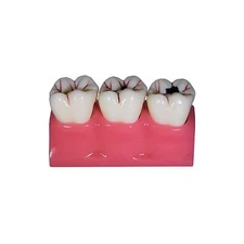Redland Dental Demonstration  CavityTeeth Educational Model And Sales - 