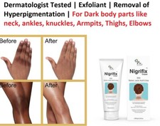 Fixderma Nigrifix Cream for Acanthosis Nigricans For Dark Body Parts
