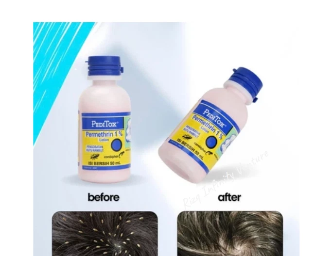 TWIN Pack 50ml x 2 PEDITOX–Remove Lice & Nits Quickly,Safely,No More Itchy Head - Изображение 3 из 3
