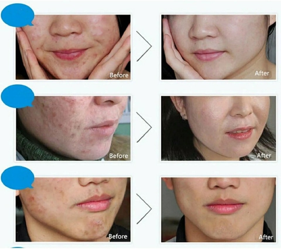 BIOAQUA Face Skin Care Acne Treatment Removal Cream Spots Scar Blemish