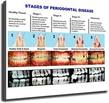 Dental Clinic Wall Poster Periodontal Disease Staging Chart Poster Painting