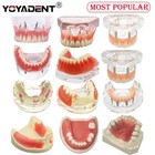 <!--F#f_0-->Dental Model Teeth Model upper jaw/Lower Jaw Implant Restoration Model<!--F/-->