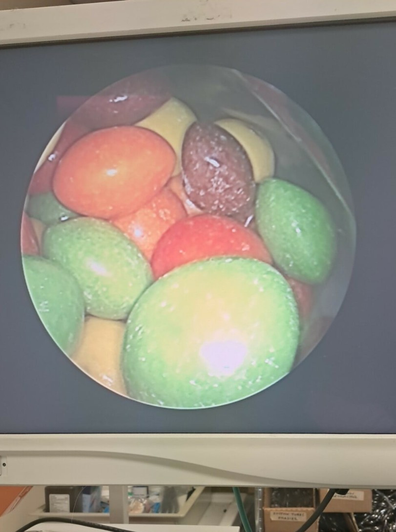 Hologic MyoSure 40-200 Operative Hysteroscope w/40-201 Removable Outflow Channel