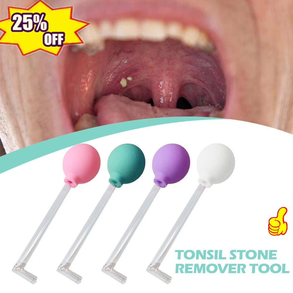 Tonsil Stone Removal