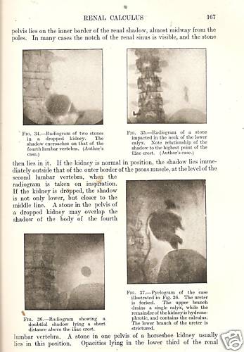 Stone And Calculous Disease by J Swift Joly ILLUS 1940 - Bild 1 von 2