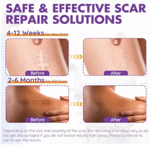 Silicone Scar Sheets & Tape Roll (3M) | Scar Removal, Keloid,Surgery, Acne,Marks - Picture 4 of 4