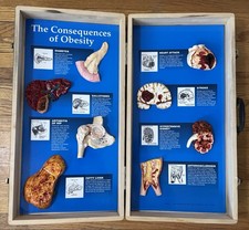 Health EDCO The Consequences of Obesity Teach...