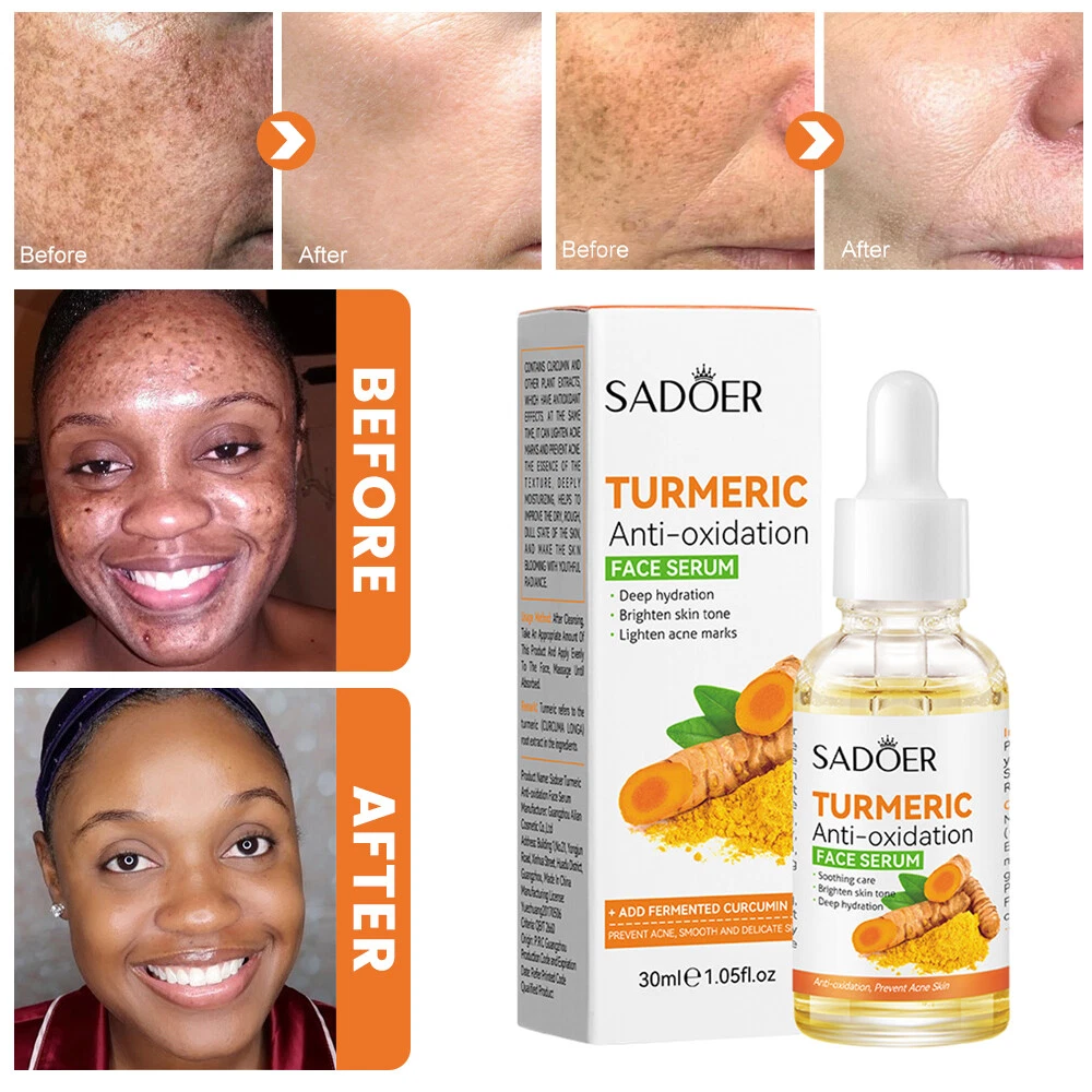 Turmeric Anti-oxidation Serum Essence,Turmeric Serum for Anti-Oxygen Dark Spots | eBay