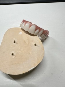 Full Upper Denture With 6 Implants Titanium Bar For Display Only