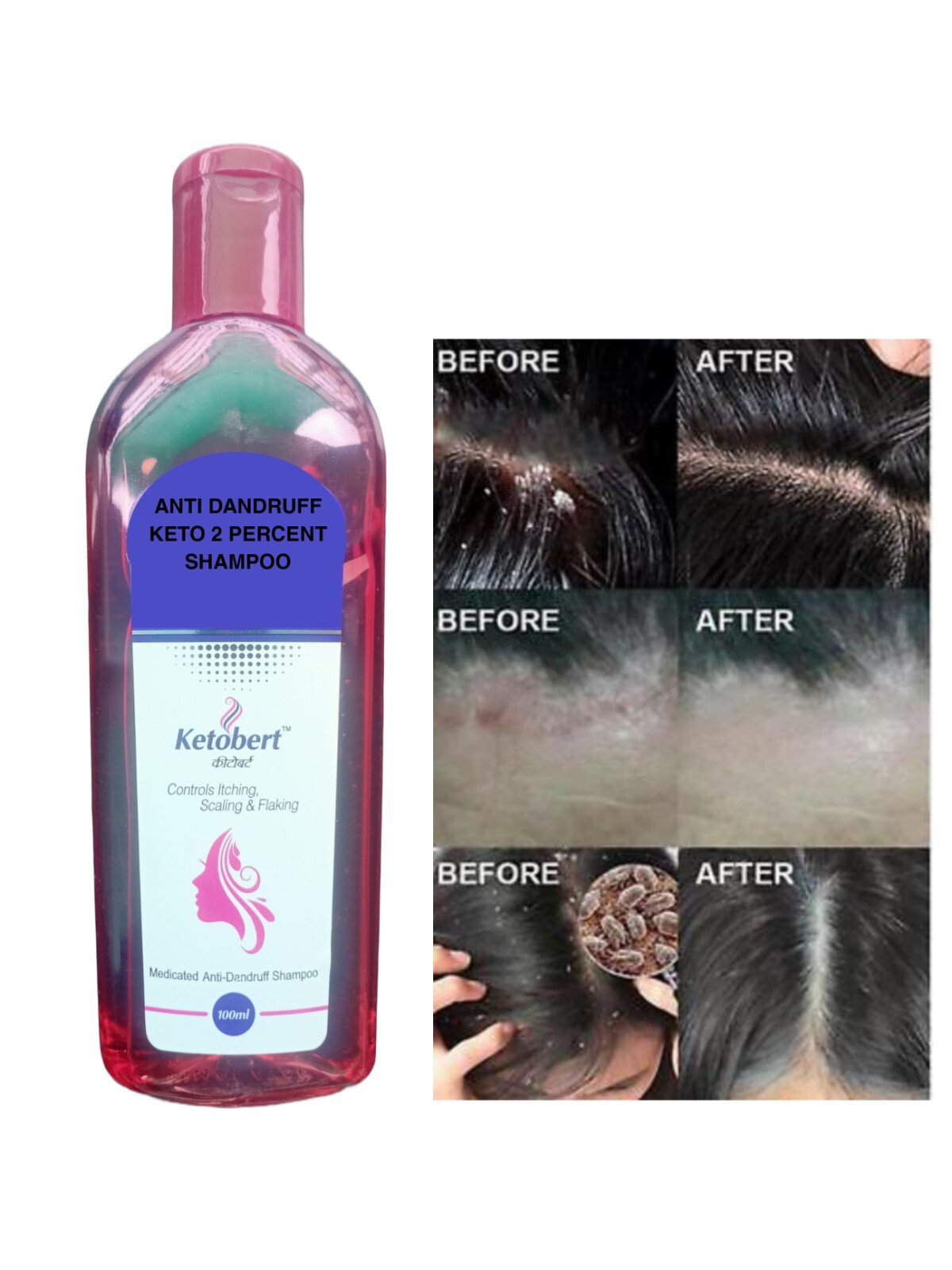 Keto Hair Follicle Shampoo Antibacterial Antifungal Itching Mites Oil