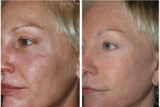 AntiAging SkinCare Kit for Older Skin-Cleanser, Serum, Peel, Toner, Moisturizer